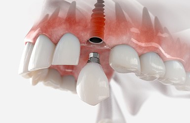 Digital image of the dental implant parts