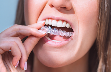 Woman placing an Invisalign clear aligner over her teeth