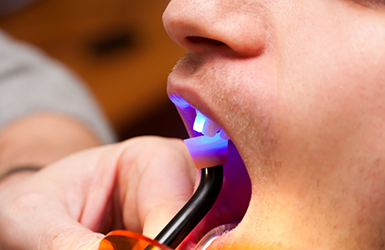 Close up of a dental patient having an ultraviolet light applied to their tooth