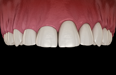 Illustration of a mouth with an uneven gumline