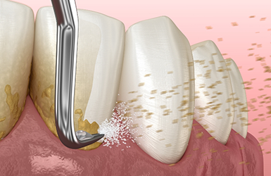 Illustration of a dental scaler clearing tartar buildup from the gumline