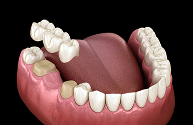 Illustration of a dental bridge being placed over two teeth to fill the gap between them