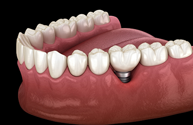 Illustration of a dental implant with a dental crown replacing a missing teeth