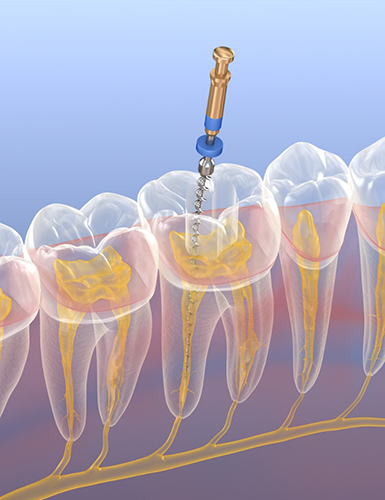 Illustration of a thin dental instrument treating the inside of a tooth