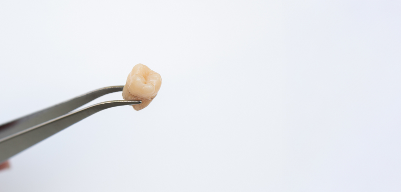 Tweezers holding an extracted tooth