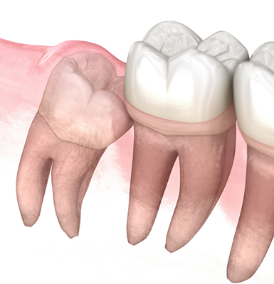 Illustration of an impacted tooth pressing against the adjacent tooth
